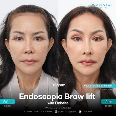 Endoscopic Brow Lift before and after results at Wansiri Hospital Bangkok