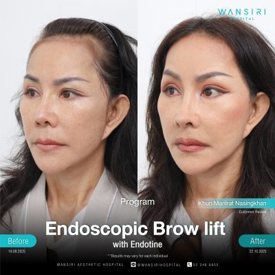 Endoscopic Brow Lift before and after results at Wansiri Hospital Bangkok