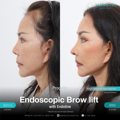 Endoscopic Brow Lift before and after results at Wansiri Hospital Bangkok