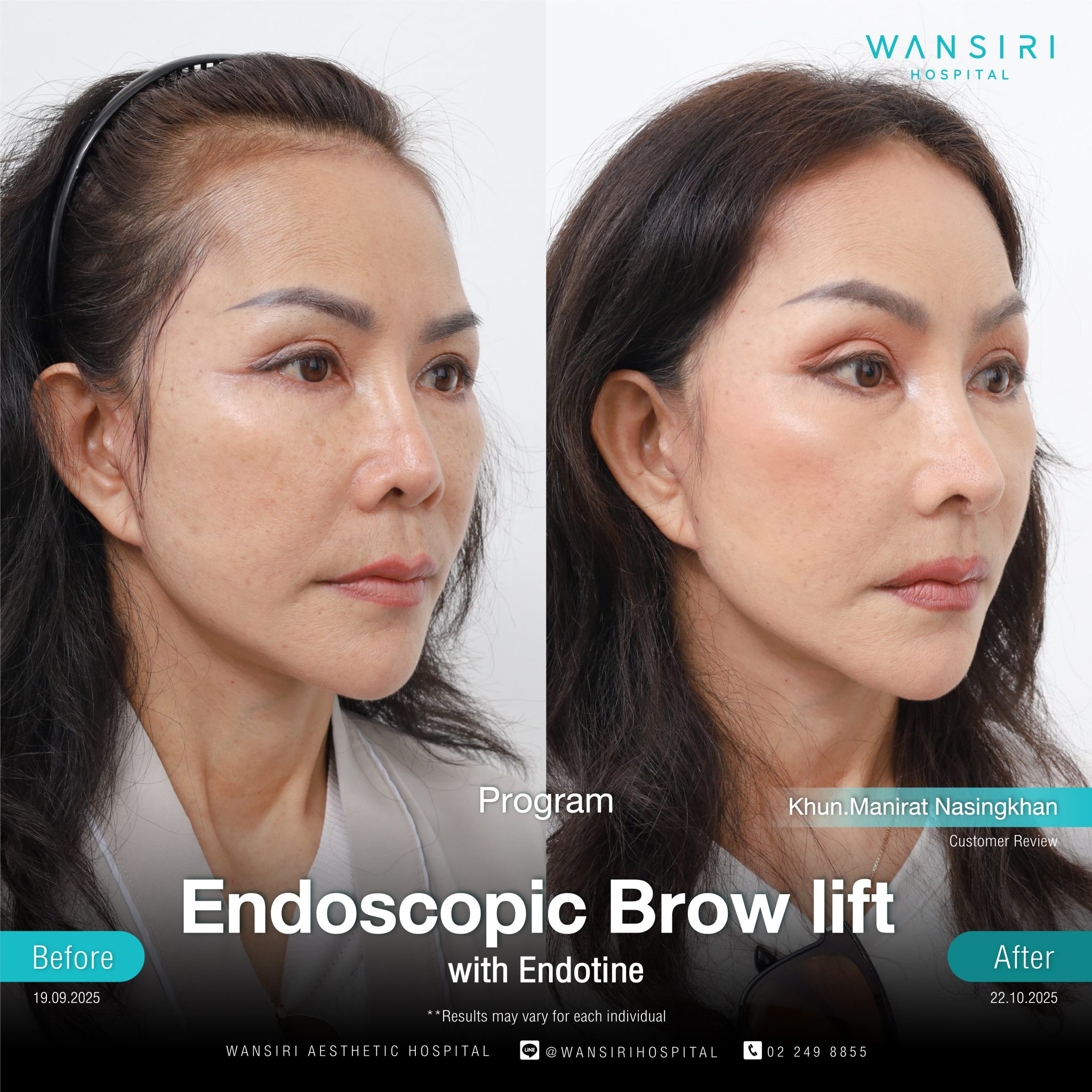 Endoscopic Brow Lift before and after results at Wansiri Hospital Bangkok