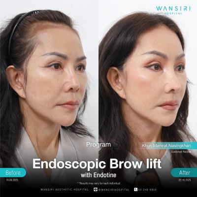 Endoscopic Brow Lift before and after results at Wansiri Hospital Bangkok
