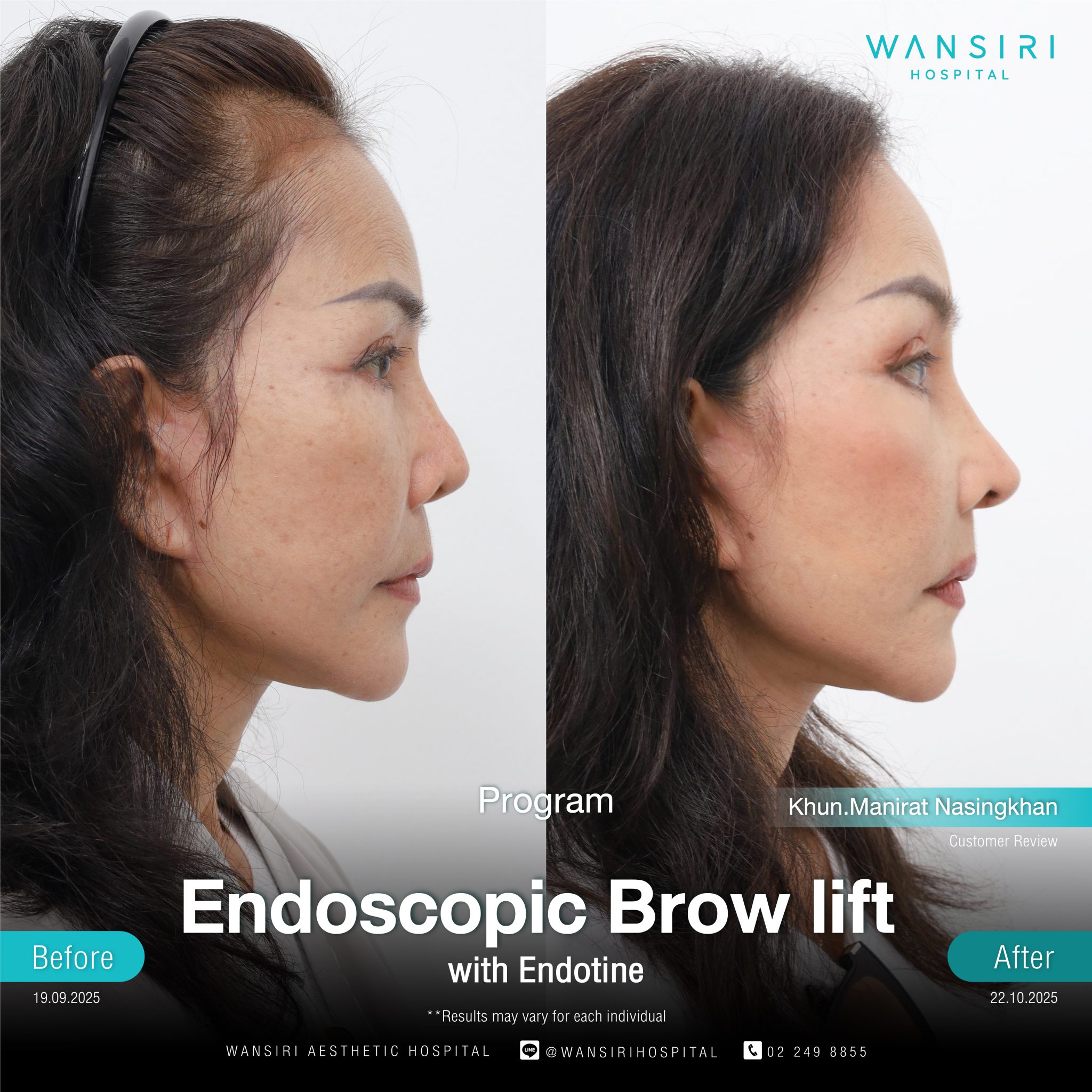 Endoscopic Brow Lift before and after results at Wansiri Hospital Bangkok