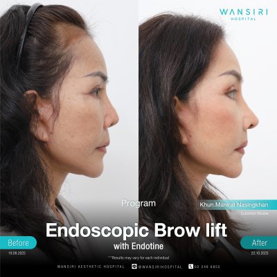 Endoscopic Brow Lift before and after results at Wansiri Hospital Bangkok