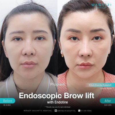 Endoscopic Brow Lift before and after results at Wansiri Hospital Bangkok