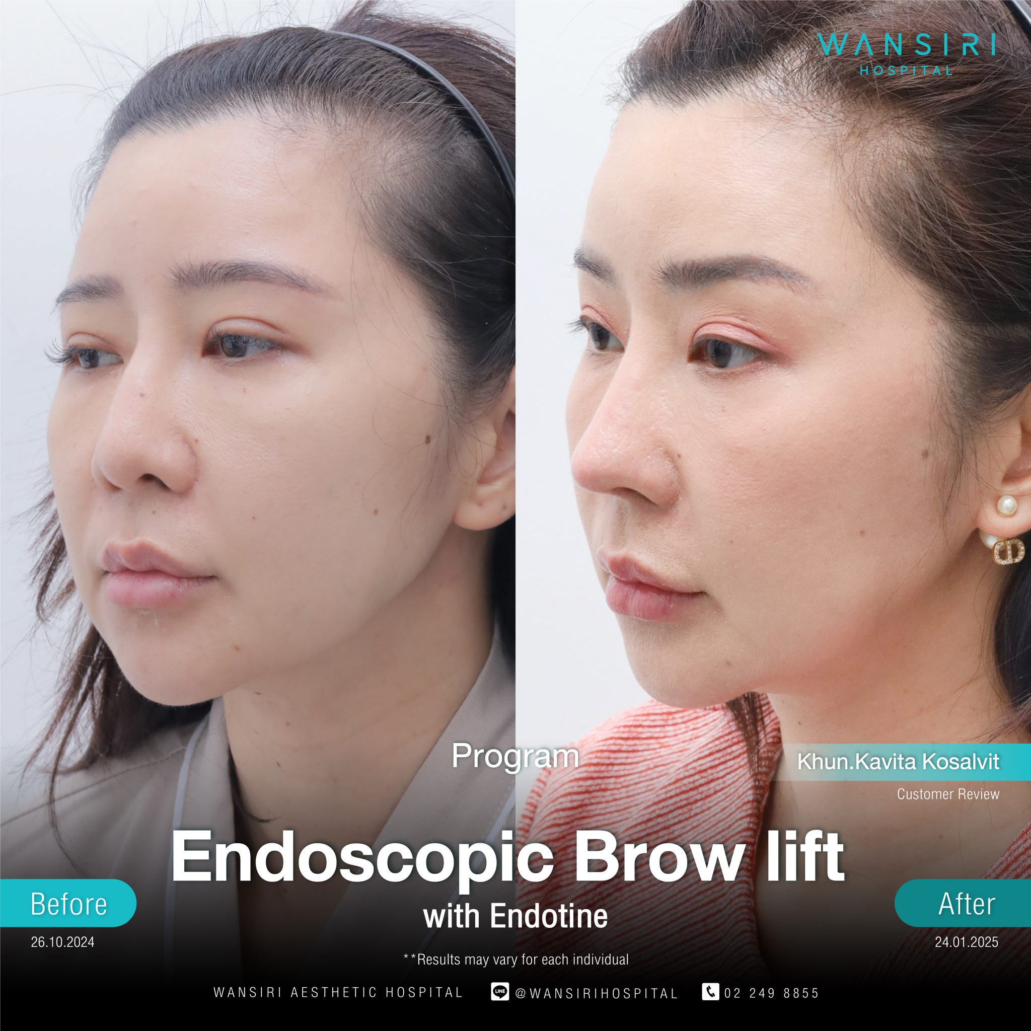 Endoscopic Brow Lift before and after results at Wansiri Hospital Bangkok