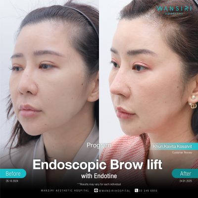 Endoscopic Brow Lift before and after results at Wansiri Hospital Bangkok