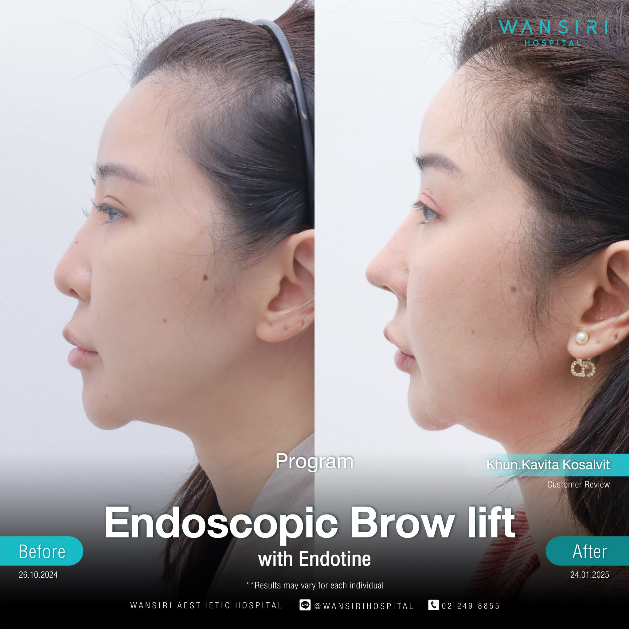 Endoscopic Brow Lift before and after results at Wansiri Hospital Bangkok