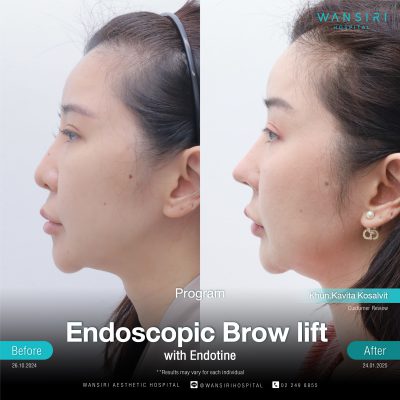 Endoscopic Brow Lift before and after results at Wansiri Hospital Bangkok