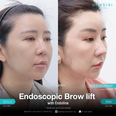 Endoscopic Brow Lift before and after results at Wansiri Hospital Bangkok