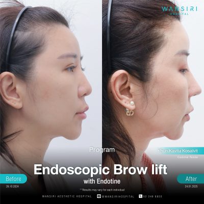 Endoscopic Brow Lift before and after results at Wansiri Hospital Bangkok
