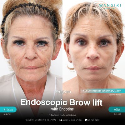 Endoscopic Brow Lift before and after results at Wansiri Hospital Bangkok