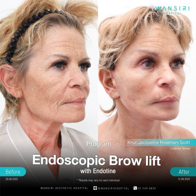 Endoscopic Brow Lift before and after results at Wansiri Hospital Bangkok
