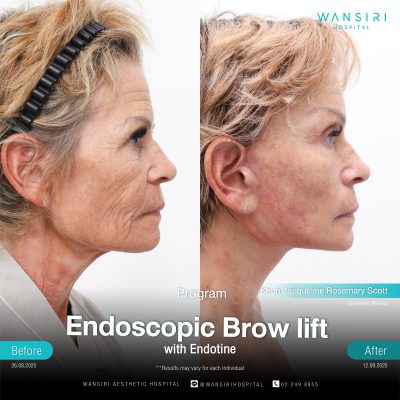 Endoscopic Brow Lift before and after results at Wansiri Hospital Bangkok