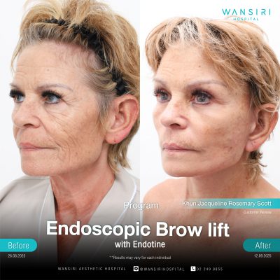 Endoscopic Brow Lift before and after results at Wansiri Hospital Bangkok