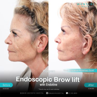 Endoscopic Brow Lift before and after results at Wansiri Hospital Bangkok