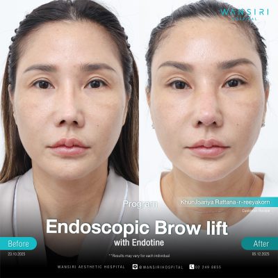 Endoscopic Brow Lift before and after results at Wansiri Hospital Bangkok