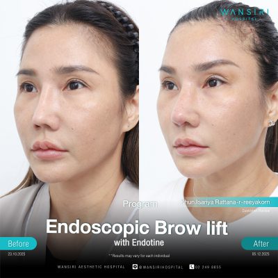 Endoscopic Brow Lift before and after results at Wansiri Hospital Bangkok
