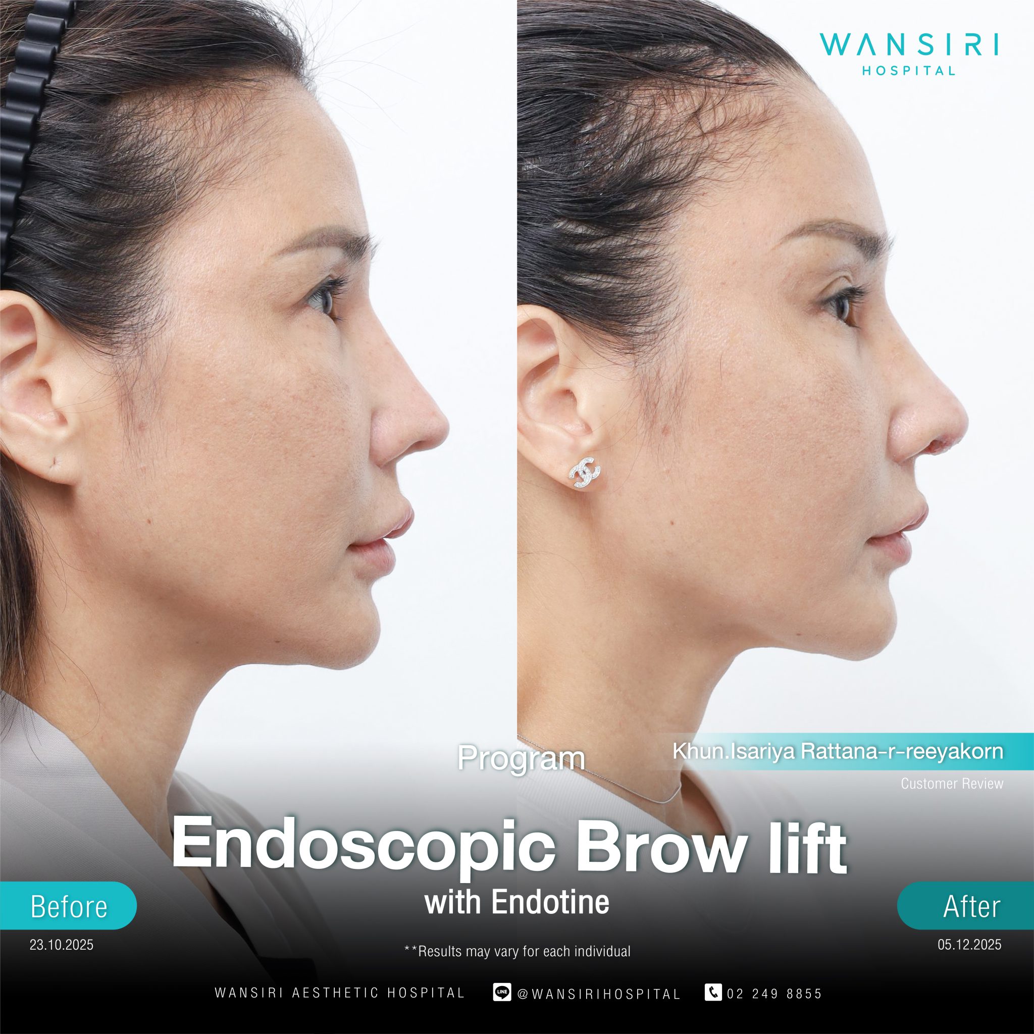 Endoscopic Brow Lift before and after results at Wansiri Hospital Bangkok