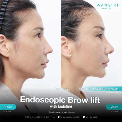 Endoscopic Brow Lift before and after results at Wansiri Hospital Bangkok