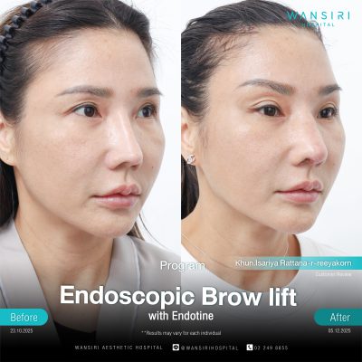 Endoscopic Brow Lift before and after results at Wansiri Hospital Bangkok