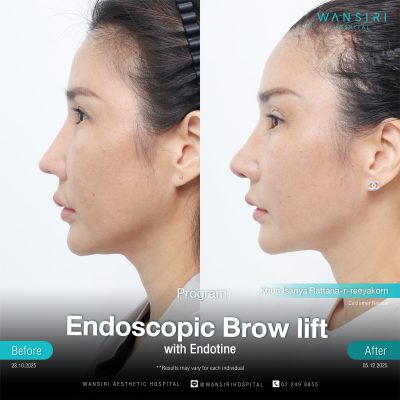 Endoscopic Brow Lift before and after results at Wansiri Hospital Bangkok