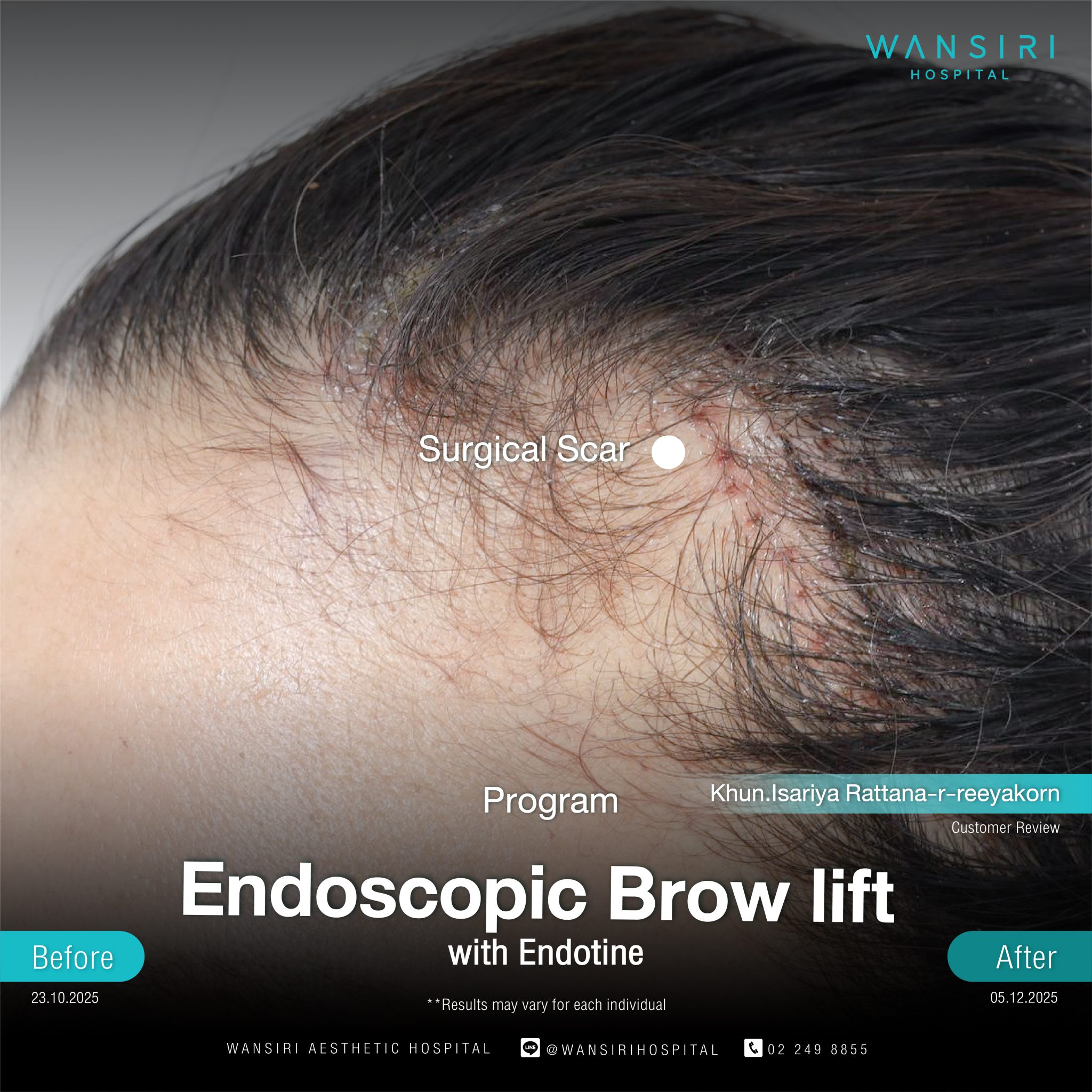 Endoscopic Brow Lift before and after results at Wansiri Hospital Bangkok