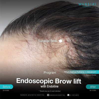 Endoscopic Brow Lift before and after results at Wansiri Hospital Bangkok