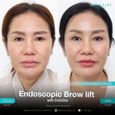 Endoscopic Brow Lift before and after results at Wansiri Hospital Bangkok
