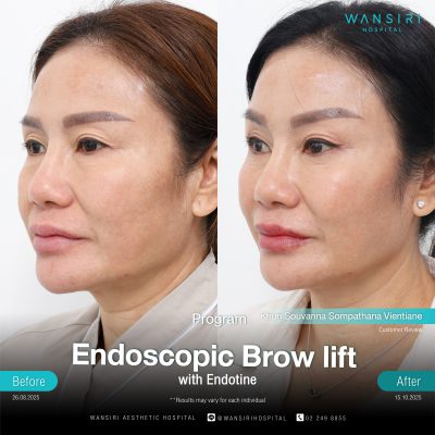 Endoscopic Brow Lift before and after results at Wansiri Hospital Bangkok
