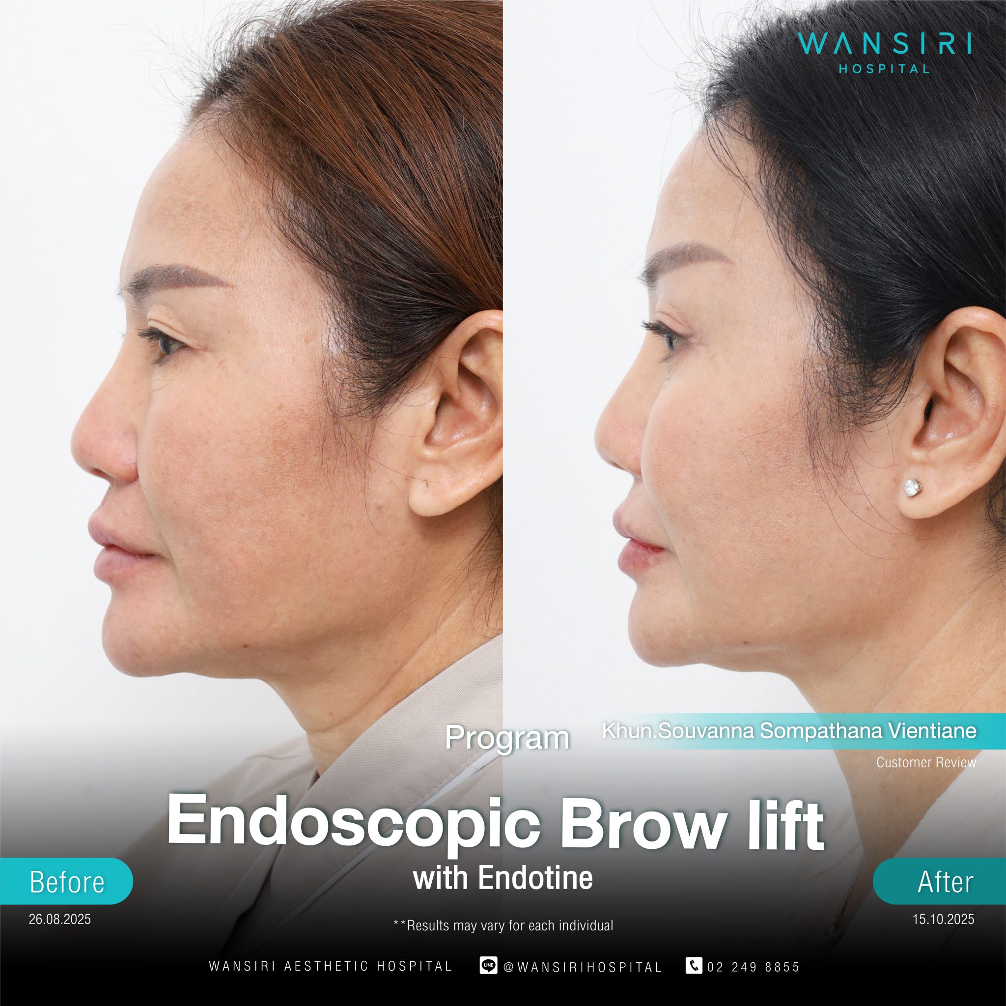 Endoscopic Brow Lift before and after results at Wansiri Hospital Bangkok