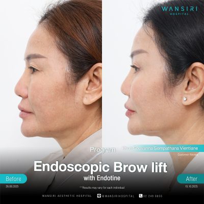Endoscopic Brow Lift before and after results at Wansiri Hospital Bangkok