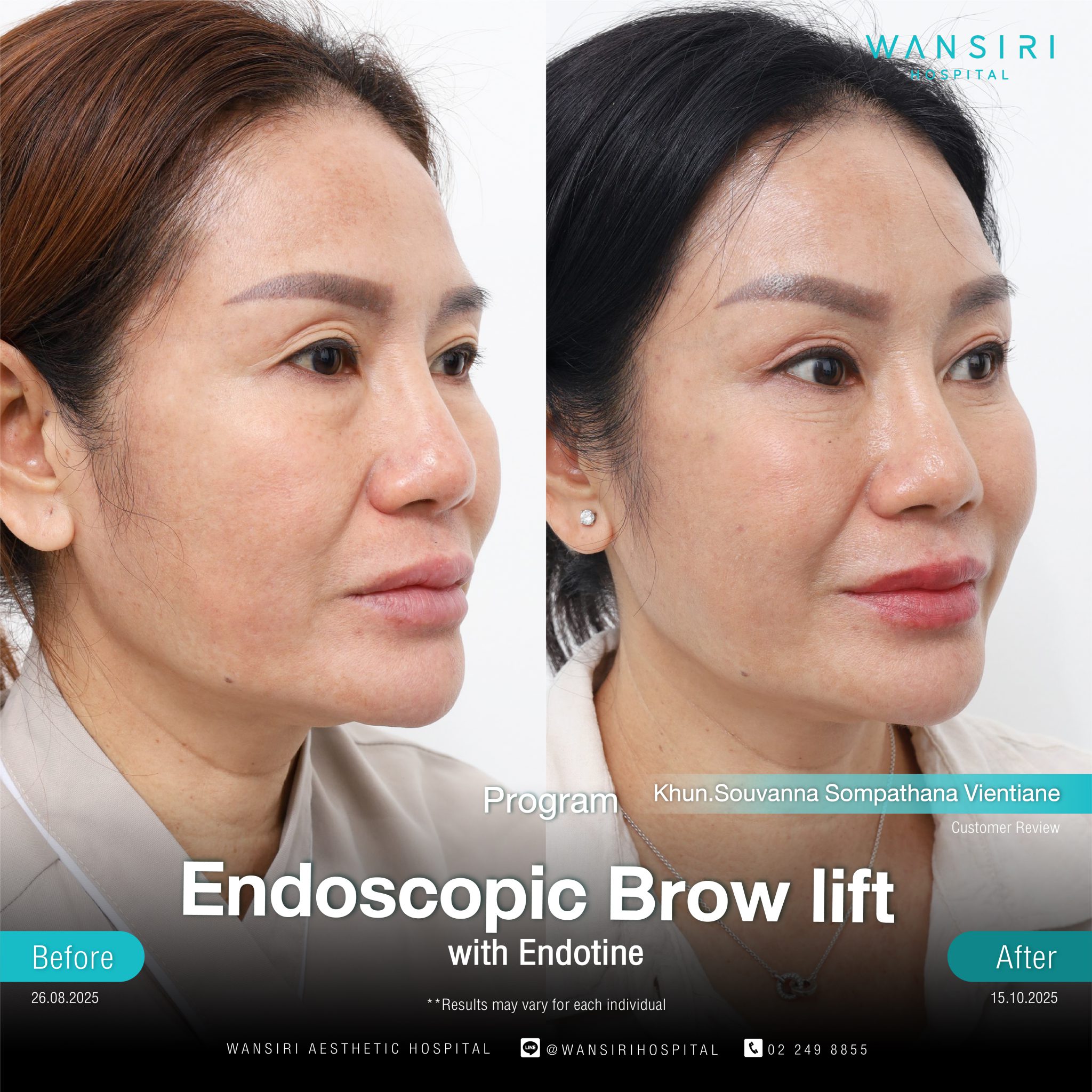 Endoscopic Brow Lift before and after results at Wansiri Hospital Bangkok