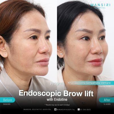 Endoscopic Brow Lift before and after results at Wansiri Hospital Bangkok