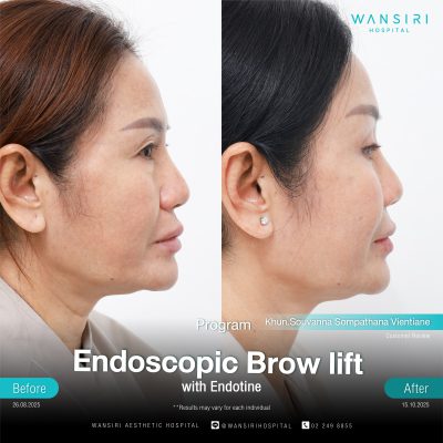 Endoscopic Brow Lift before and after results at Wansiri Hospital Bangkok