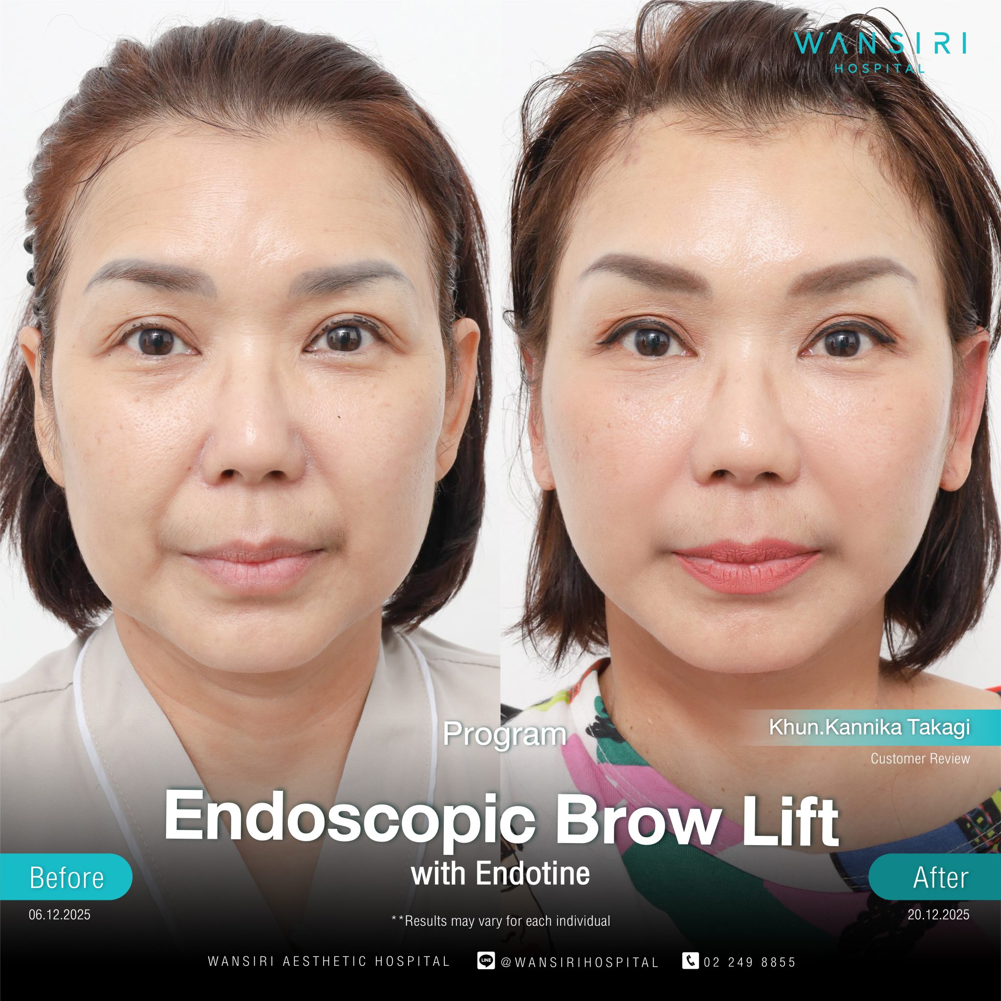 Endoscopic Brow Lift before and after results at Wansiri Hospital Bangkok