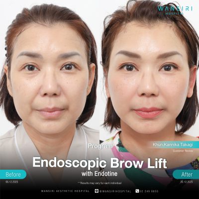 Endoscopic Brow Lift before and after results at Wansiri Hospital Bangkok