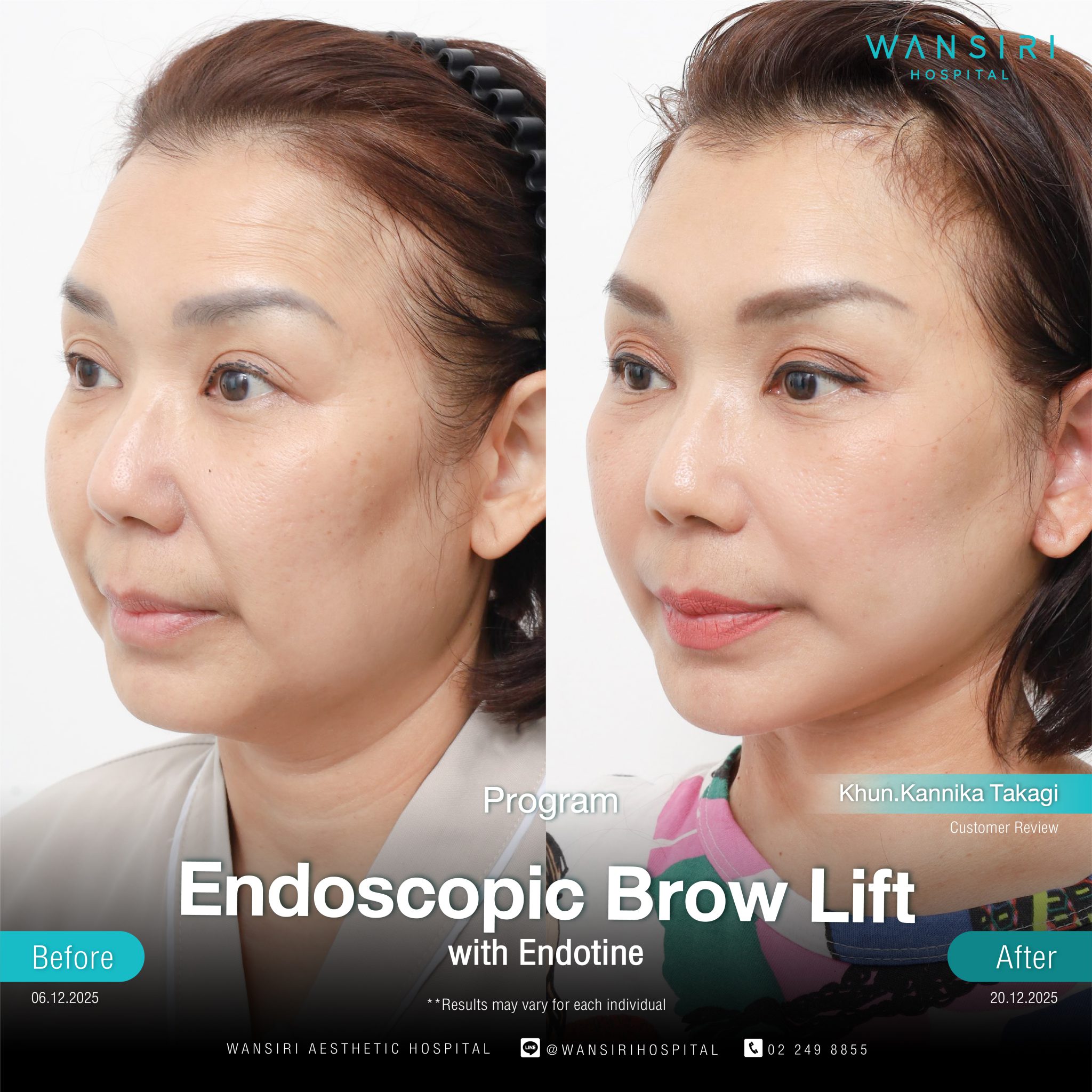 Endoscopic Brow Lift before and after results at Wansiri Hospital Bangkok