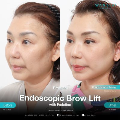 Endoscopic Brow Lift before and after results at Wansiri Hospital Bangkok