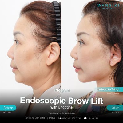 Endoscopic Brow Lift before and after results at Wansiri Hospital Bangkok