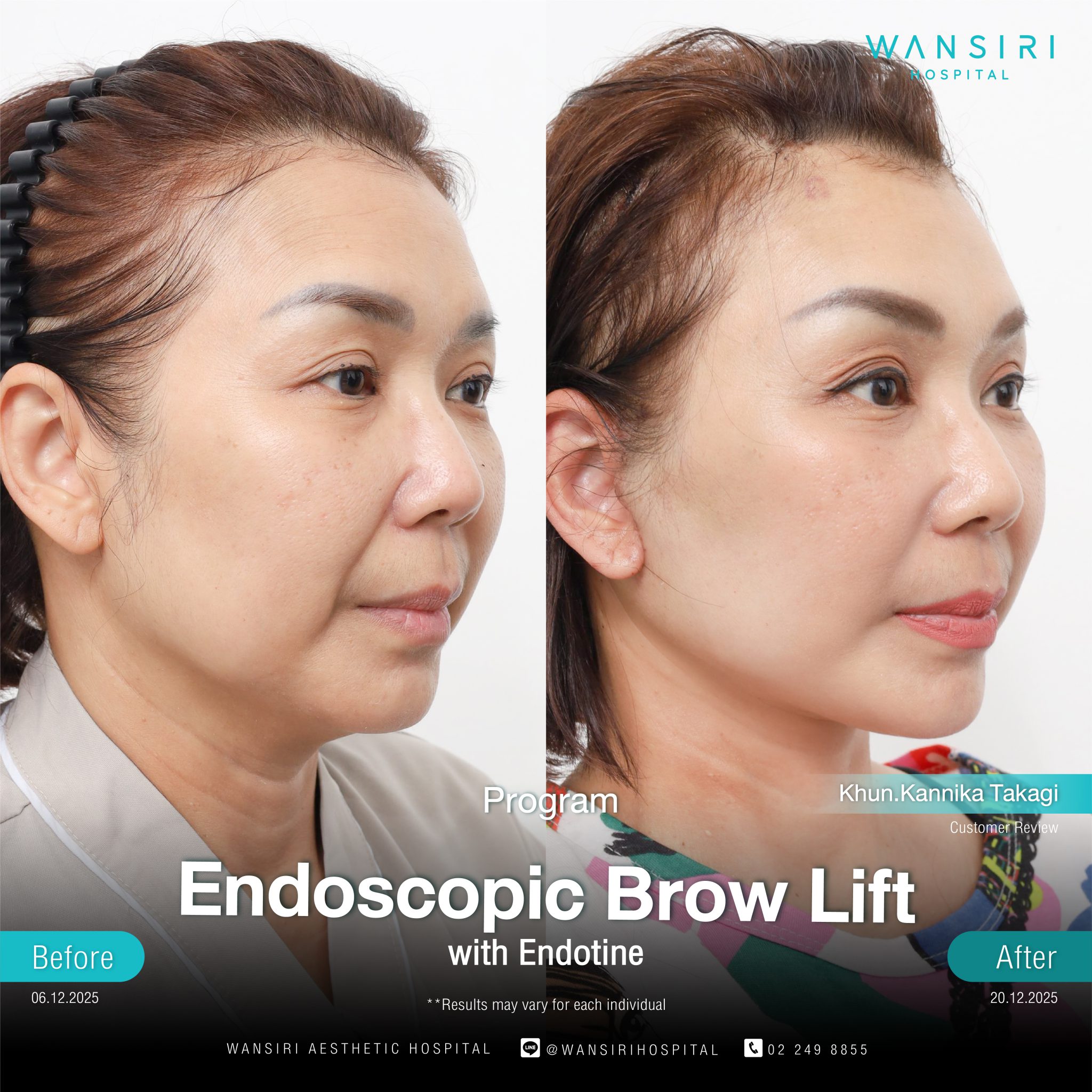 Endoscopic Brow Lift before and after results at Wansiri Hospital Bangkok