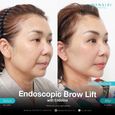 Endoscopic Brow Lift before and after results at Wansiri Hospital Bangkok