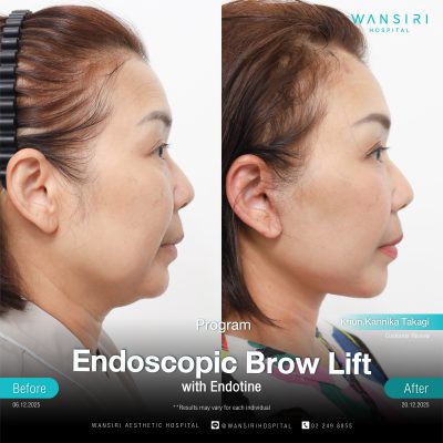 Endoscopic Brow Lift before and after results at Wansiri Hospital Bangkok