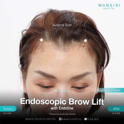 Endoscopic Brow Lift before and after results at Wansiri Hospital Bangkok