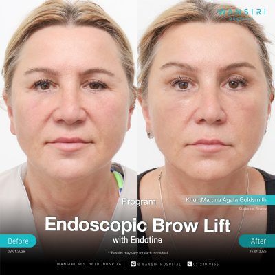 Endoscopic Brow Lift before and after results at Wansiri Hospital Bangkok