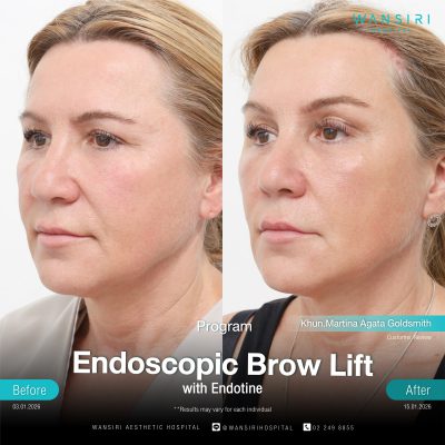 Endoscopic Brow Lift before and after results at Wansiri Hospital Bangkok