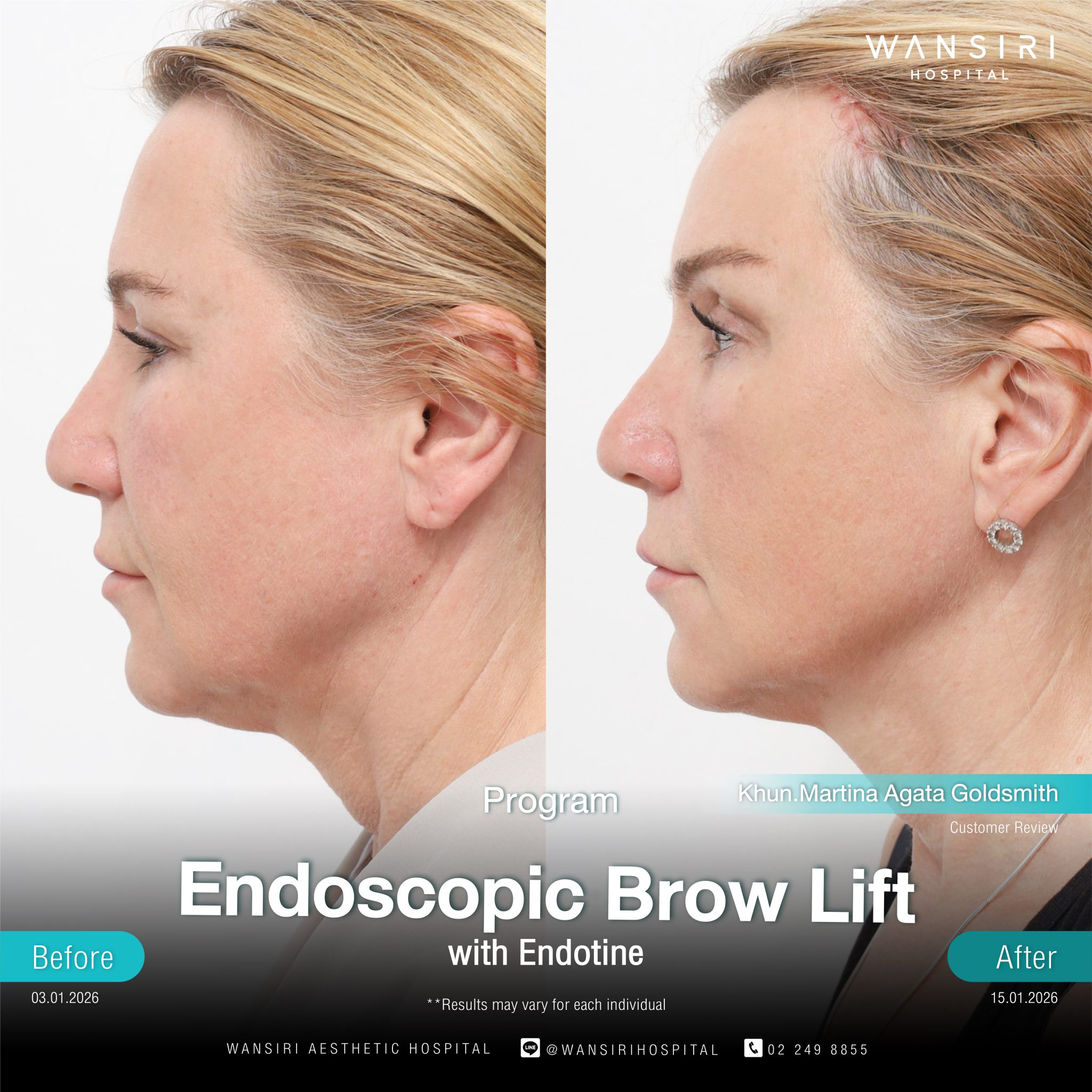 Endoscopic Brow Lift before and after results at Wansiri Hospital Bangkok