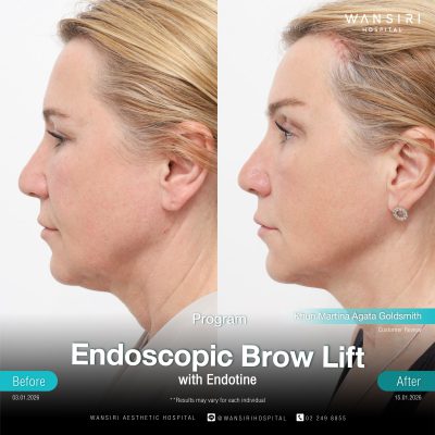 Endoscopic Brow Lift before and after results at Wansiri Hospital Bangkok