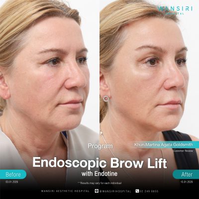 Endoscopic Brow Lift before and after results at Wansiri Hospital Bangkok