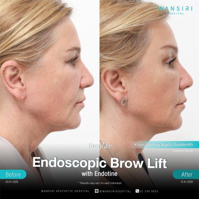 Endoscopic Brow Lift before and after results at Wansiri Hospital Bangkok