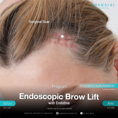 Endoscopic Brow Lift before and after results at Wansiri Hospital Bangkok